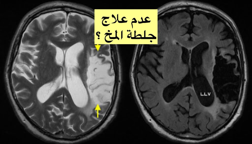 ماذا يترتب عن عدم علاج جلطة المخ