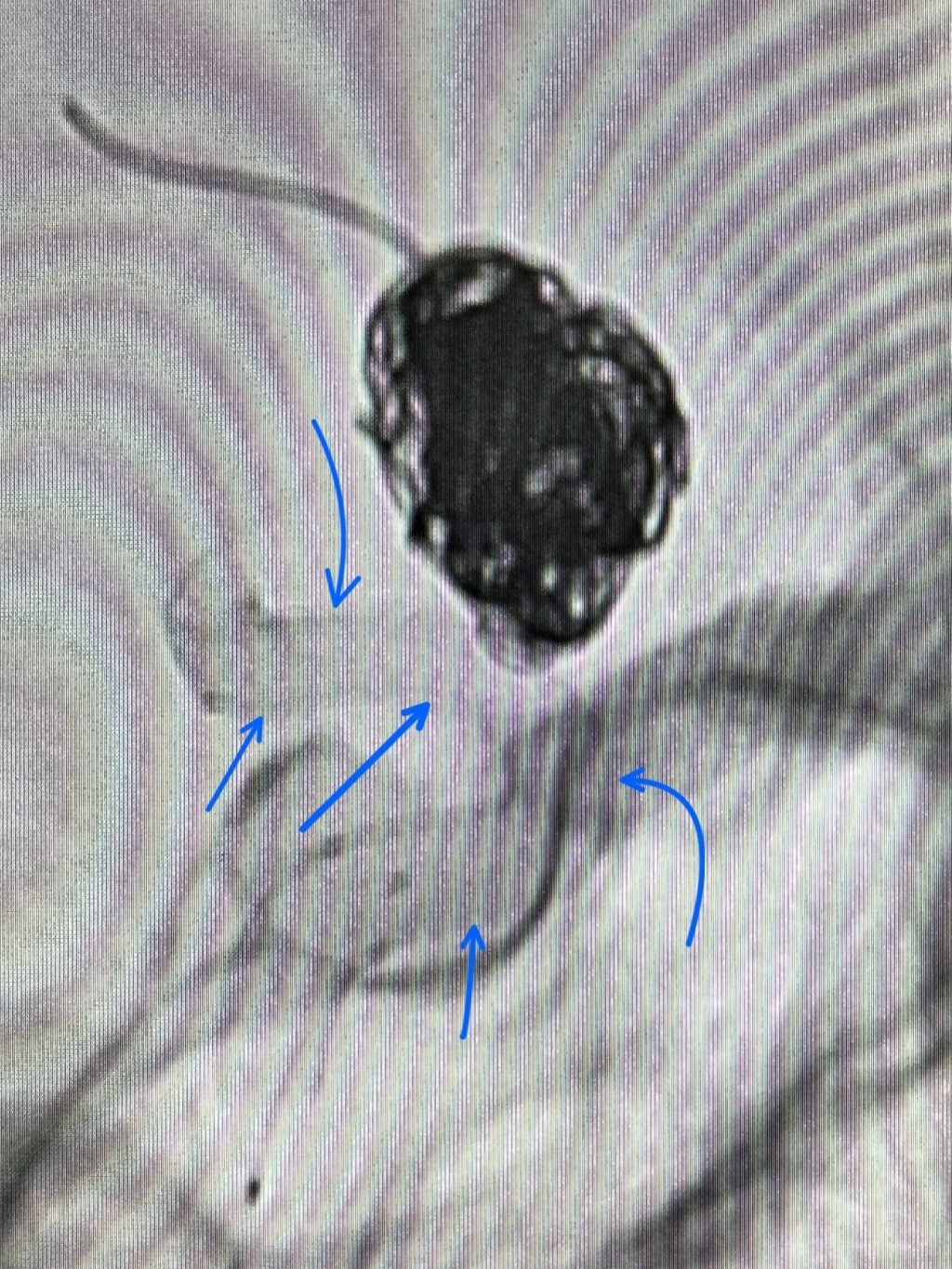 نمو التمدد الشرياني بالمخ من جديد